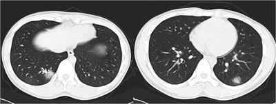Clinical and radiological characteristics of pediatric COVID-19 before and after the Omicron outbreak: a multi-center study